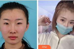 廈門大學(xué)附屬?gòu)B門眼科中心醫(yī)院任小軍整形價(jià)格表附全切雙眼皮+開內(nèi)眼角+開外眼角案例展示