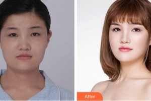 廈門大學(xué)附屬?gòu)B門眼科中心醫(yī)院何雪洪整形價(jià)格表附眼部綜合日記案例展示