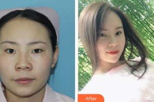 廈門大學(xué)附屬?gòu)B門眼科中心醫(yī)院楊麗杰整形價(jià)格表附精細(xì)切開雙眼皮案例展示