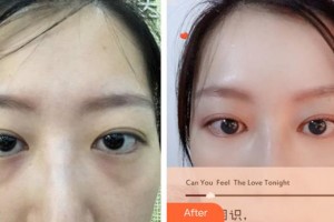 廈門大學(xué)附屬?gòu)B門眼科中心醫(yī)院許亞章整形價(jià)格表附內(nèi)路去眼袋案例展示