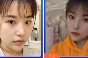 廈門大學(xué)附屬?gòu)B門眼科中心醫(yī)院王晶整形價(jià)格表附切開重瞼伴提肌+內(nèi)眥開大術(shù)案例展示