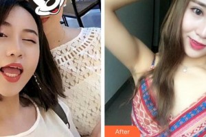 廈門大學(xué)附屬廈門眼科中心醫(yī)院王樂整形價(jià)格表附雙眼皮案例展示