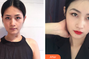 廣州鴻業(yè)醫(yī)學(xué)美容門診部巫勝君整形價(jià)格表附增生疤痕案例展示