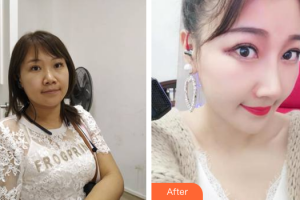 廣州解放軍第四五八醫(yī)院激光整形美容中心劉躍飛整形價(jià)格表附隆鼻案例展示