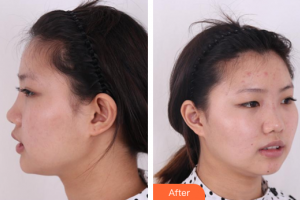 廣州鴻業(yè)醫(yī)學(xué)美容門診部羅良俊整形價(jià)格表附鼻部綜合案例展示