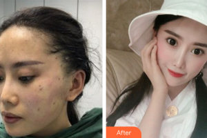 廣州廣大整形美容醫(yī)院查旭山整形價(jià)格表附埋線提升案例展示