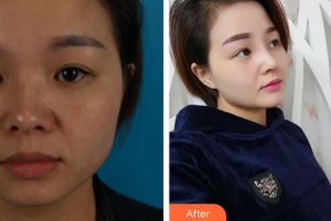 廣州廣大整形美容醫(yī)院程喜平整形價(jià)格表附鼻部手術(shù)案例展示