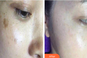 南方醫(yī)科大學(xué)附屬廣州燕嶺醫(yī)院整形美容中心郭芳整形價(jià)格表附激光祛色素沉著疤痕案例展示