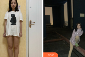 廣州瑞港醫(yī)療美容門診部盧顯碧整形價格表附吸脂瘦大腿案例展示