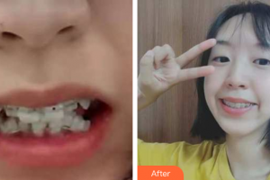 廣州瑞港醫(yī)療美容門診部王正云整形價格表附牙齒矯正案例展示