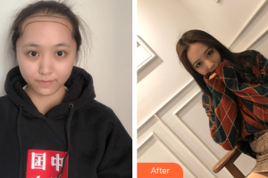 廣州壹加壹美容醫(yī)院胡準整形價格表附發(fā)際線種植案例展示