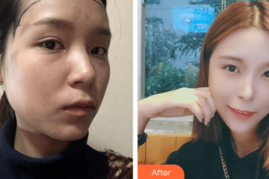 廣州瑞港醫(yī)療美容門診部肖醫(yī)生整形價格表附發(fā)際線種植案例展示