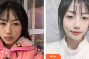 廣州愛來（原阿瑪施）醫(yī)療美容整形醫(yī)院吳文芹整形價格表附微創(chuàng)疤痕修復案例展示