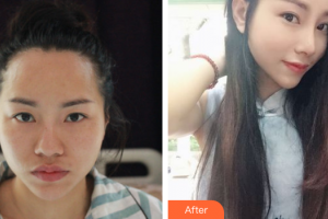 廣州美恩整形美容醫(yī)院南華整形價格表附肋軟骨隆鼻案例展示