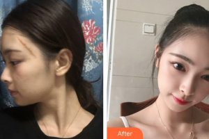 廣州中家醫(yī)家庭醫(yī)生醫(yī)學整形美容醫(yī)院賴崢嶸整形價格表附激光祛疤案例展示