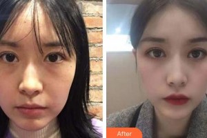 廈門大學(xué)附屬廈門眼科中心醫(yī)院林淑玲整形價(jià)格表附眼修復(fù)案例展示