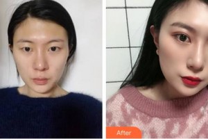 廈門大學(xué)附屬廈門眼科中心醫(yī)院付彥敏整形價(jià)格表附眼部手術(shù)案例展示