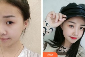 廈門大學(xué)附屬廈門眼科中心醫(yī)院莊建福整形價(jià)格表附眼部手術(shù)案例展示