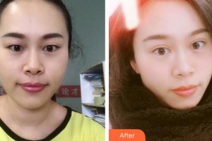 廈門大學(xué)附屬廈門眼科中心醫(yī)院王海燕整形價(jià)格表附眼部手術(shù)案例展示