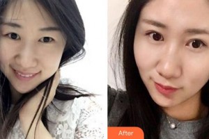 廈門大學(xué)附屬廈門眼科中心醫(yī)院胡繼發(fā)整形價(jià)格表附眼部綜合案例展示