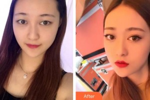 廈門大學附屬廈門眼科中心醫(yī)院龔頌建整形價格表附玫瑰花雨的雙眼皮案例展示