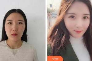 廈門大學附屬廈門眼科中心醫(yī)院李勇整形價格表附眼部綜合案例展示