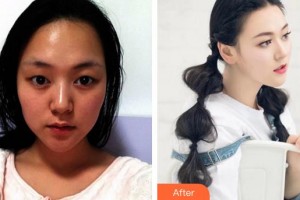 廈門大學附屬廈門眼科中心醫(yī)院陳惠嬋整形價格表附雙眼皮案例展示