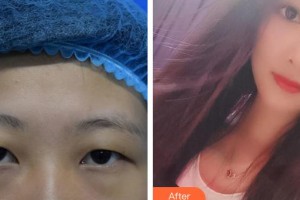 廈門大學附屬廈門眼科中心醫(yī)院王曉波整形價格表附眼部手術案例展示