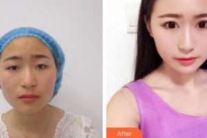 廈門大學附屬廈門眼科中心醫(yī)院黃艷明整形價格表附眼部整形案例展示