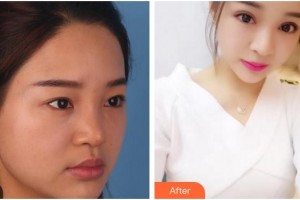 廈門大學附屬廈門眼科中心醫(yī)院黃秋萍整形價格表附切開雙眼皮案例展示