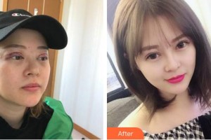 廈門大學附屬廈門眼科中心醫(yī)院吳東海整形價格表附胎生隱形雙眼皮修復案例展示