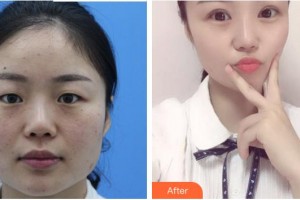 廈門大學附屬廈門眼科中心醫(yī)院江國華整形價格表附一眼愛上你的雙眼皮案例展示