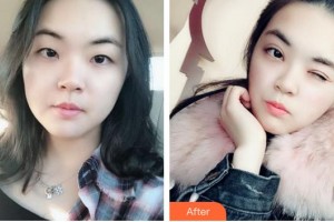 廈門大學附屬廈門眼科中心醫(yī)院陳亮整形價格表附眼部整形案例展示