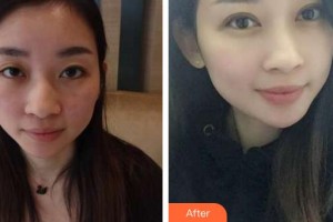 廈門大學附屬廈門眼科中心醫(yī)院李明翰整形價格表附雙眼皮案例展示