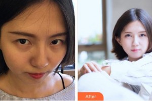 廈門大學附屬廈門眼科中心醫(yī)院康克明整形價格表附切開雙眼皮案例展示