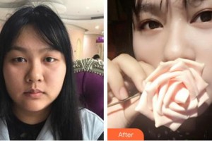 廈門大學附屬廈門眼科中心醫(yī)院張小虎整形價格表附切開雙眼皮案例展示