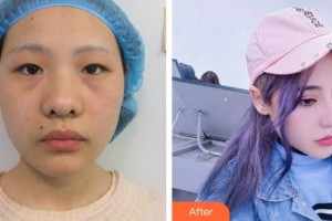 廈門大學附屬廈門眼科中心醫(yī)院黃維藝整形價格表附眼部綜合案例展示