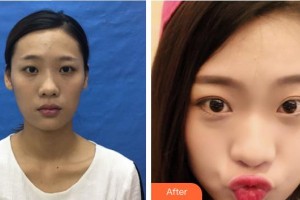 廈門大學附屬廈門眼科中心醫(yī)院鄧坤明整形價格表附眼部綜合案例展示