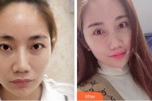 廈門大學附屬廈門眼科中心醫(yī)院鄭林整形價格表附定點雙眼皮案例展示