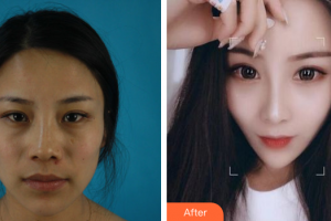 廣州廣大整形美容醫(yī)院秦瑜整形價格表附鼻部手術(shù)案例展示