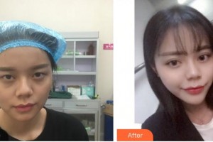 廈門大學附屬廈門眼科中心醫(yī)院李瑞霞整形價格表附眼部手術案例展示