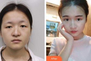 廈門大學附屬廈門眼科中心醫(yī)院史小玲整形價格表附切開雙眼皮 媚眼如絲案例展示