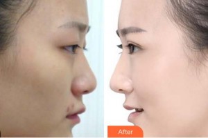 廈門大學附屬廈門眼科中心醫(yī)院林青鴻整形價格表附眼部整形案例展示