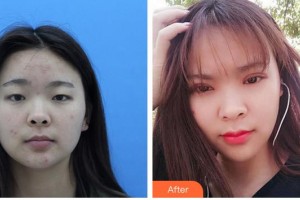 廈門大學附屬廈門眼科中心醫(yī)院羅向東整形價格表附切開雙眼皮案例展示