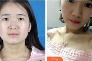 廈門大學附屬廈門眼科中心醫(yī)院吳媛整形價格表附雙眼皮案例展示