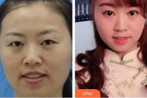 廈門大學附屬廈門眼科中心醫(yī)院陳彥茹整形價格表附眼部案例展示