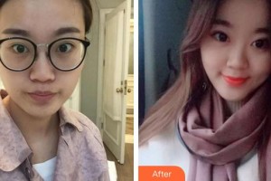 廈門大學附屬廈門眼科中心醫(yī)院劉今坤住院醫(yī)師整形價格表附切開雙眼皮案例展示