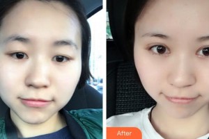 廈門大學附屬廈門眼科中心醫(yī)院劉名威整形價格表附眼部整形案例展示