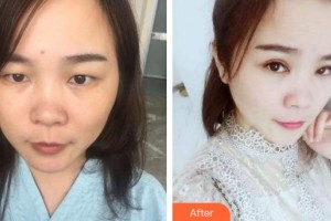 廈門大學附屬廈門眼科中心醫(yī)院陳龍龍住院醫(yī)師整形價格表附眼部整形案例展示