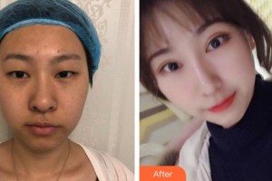 廈門大學附屬廈門眼科中心醫(yī)院況坤整形價格表附雙眼皮+內外眼角案例展示